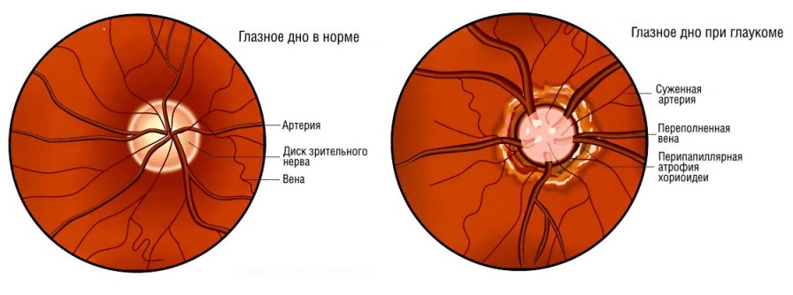 Что может увидеть окулист в глазном дне. Старческая макулярная дистрофия. Самые распространенные патологии глазного дна