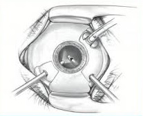 Офтальмологическая хирургия: описание, диагноз и подготовка. Глазная хирургия